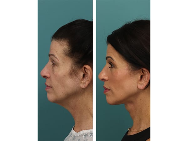 Profile Left (3)