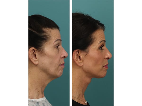 Profile Right (3)